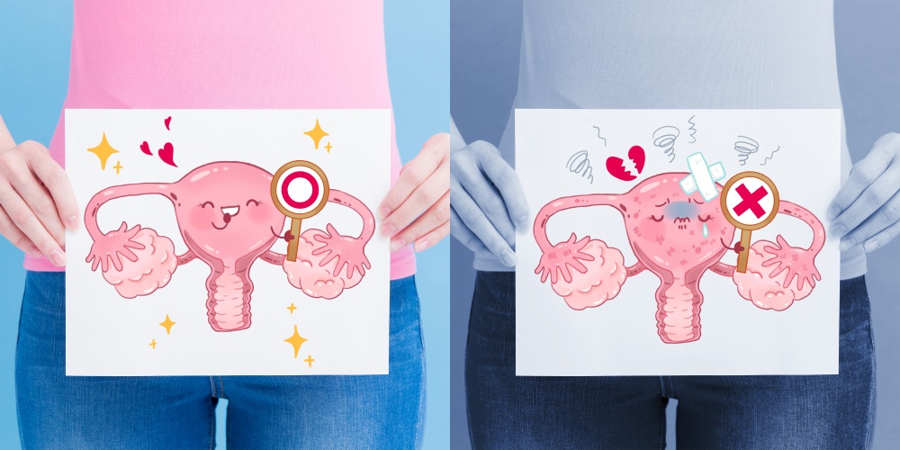 女性不孕,子宫内膜异位症,内异症不孕